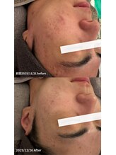 ニコ(nico)/ニキビ・肌荒れも徐々に改善