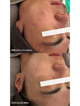 ニコ(nico)/ニキビ・肌荒れも徐々に改善