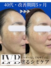 ラヴレボーテ(La Vraie Beaute)/塗るシミケア