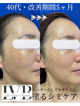 ラヴレボーテ(La Vraie Beaute)/塗るシミケア