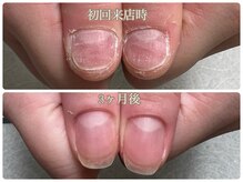 ルドネ ヴィ アシヤ(Redonner vie Ashiya)/深爪を美爪に改善コース/20代