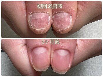 深爪を美爪に改善コース/20代