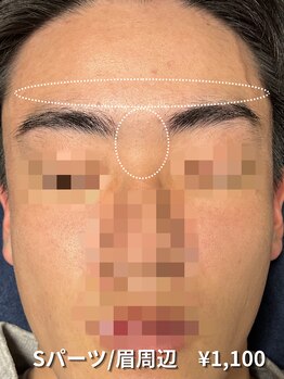 カナウ(KANAU)/【Sパーツ/脱毛】眉間・眉上