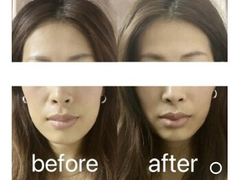 優来 神田店の写真/「持続力にこだわる本格リフトアップで理想のフェイスラインへ！超音波×ハイパーナイフ×石膏パック70分