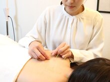 ミモザ(mimosa)/鍼デビューの方も多数◇美容鍼