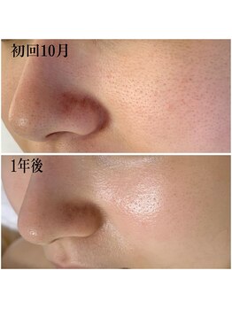 プラセル(Placer)/こんなにきれいになり