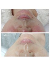 毛穴塾/【韓国最新美容】ララピール☆