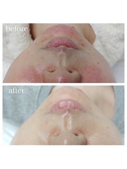 毛穴塾/【韓国最新美容】ララピール☆