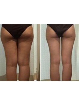 太モモ・ヒップまわりをケアしたい