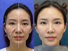 美リレア/最新ヒト幹細胞培養液導入コース