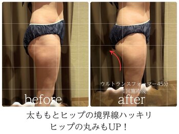 ライフチャージ(Life Charge)/筋膜リリースBefore→After