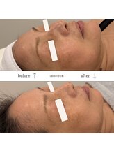 リ肌 天王寺店(Re肌)/ララピールのビフォーアフター