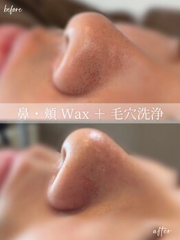 メンズ脱毛 メンズエステ エイト(8)/鼻・頬 Wax ＋ 毛穴洗浄☆