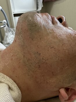 エナッシュビューティサロン(ENASH)/ヒゲ脱毛５回目照射後