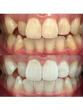 ハリス(HARIS)/セルフホワイトニング