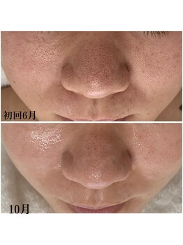 プラセル(Placer)/お肌全部が元気になっていく☆