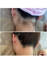 ザ ビードットデザイン(The b. design)/うなじ脱毛