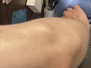 ミノシマ整体/肘内障の施術前