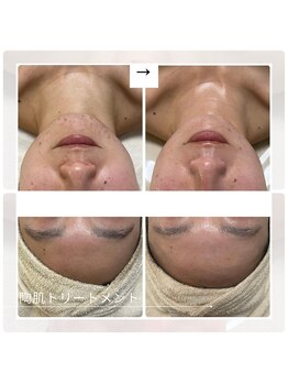 アチェリー(aCherry)/陶肌トリートメント