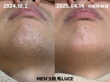 ルーチェ/【ヒゲ脱毛】自然と美意識もUP！