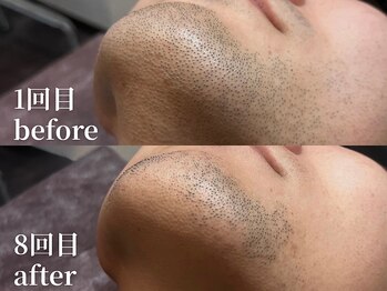 ボス 名古屋店(BOSS)/【ヒゲ脱毛　before & after】