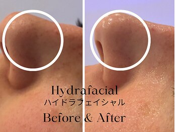 トウキョウビューティーラボ(TOKYO BEAUTY LABO.)/ハイドラBefore&After