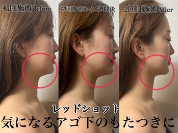 アンドエス 六本木(and S.)/フェイスラインのもたつきに！