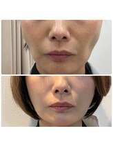 リボディ プラチナ(Rebody platinum)/小顔リフェスパーフェクトケア