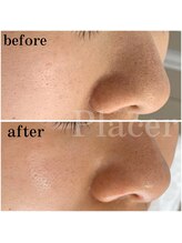 プラセル(Placer)/毛穴の黒ずみ/札幌/北区/毛穴