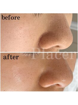 プラセル(Placer)/毛穴の黒ずみ/札幌/北区/毛穴