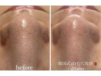 クレヴィー(Creviy)/韓国式3D毛穴洗浄1回