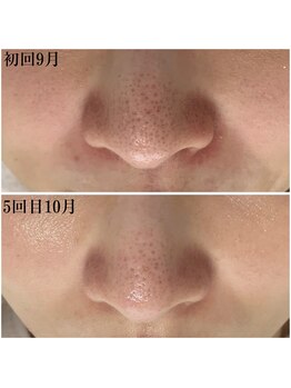 プラセル(Placer)/ずっと気になっていた鼻の毛穴…