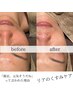 【小じわ・ほうれい線】冷房乾燥による年齢サインを徹底的に保湿◎¥8000