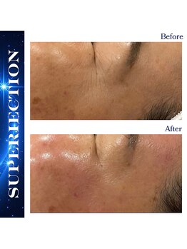 リアム(LiAm)/肌質改善スーパージェクション