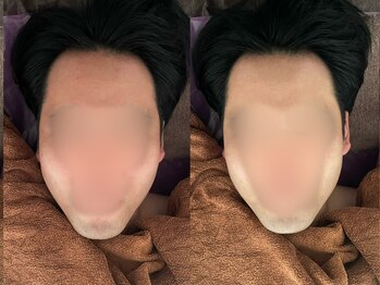 キララ(Kirara)/フェイシャルエステ1回の変化