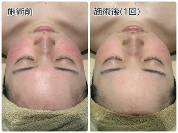 SALON　IIIINEE【稲】《韓国肌管理/ララピール/脱毛》/ハーブピーリング