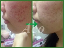 スキンケアスタジオ アコ 新宿店(Aco)の雰囲気（ハーブピーリングの本流、グリーンピールで輝く素肌へ13200円～）