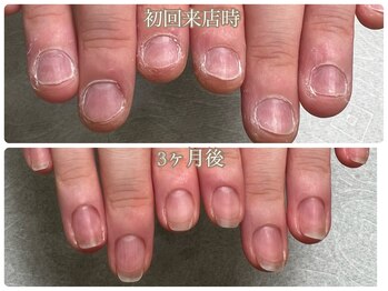 深爪を美爪に改善コース/20代