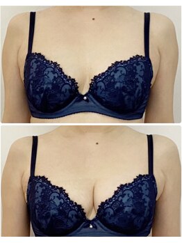 ラビス(RAVIS)/40代☆下垂・形の崩れ改善