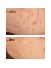 ノノサロン(nono salon)/ニキビケア