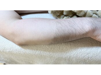 トゥルーカインド(true kind)/メンズひじ下ダブル脱毛