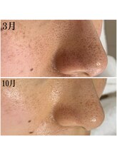 プラセル(Placer)/開き毛穴もあきらめないで！