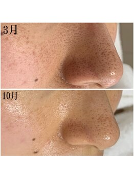 プラセル(Placer)/開き毛穴もあきらめないで!