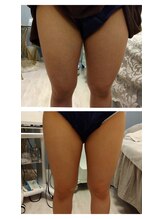 ルアナ(Luana)/とにかく結果が出る！脂肪冷却