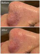 モテ 新宿店(Mote)/ハイドラ毛穴洗浄＋艶肌Wax 新宿