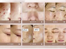 お肌悩み解消しましょう♪ハーブピーリング/ララピール