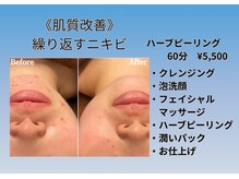 ザ リノ ビューティー 福島郡山店(The Lino Beauty)/■ハーブピーリングコース