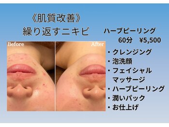 ザ リノ ビューティー 福島郡山店(The Lino Beauty)/■ハーブピーリングコース