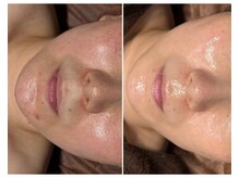 フェイスプラスリフ(FACE+RiF)/赤み、毛穴、たるみケア