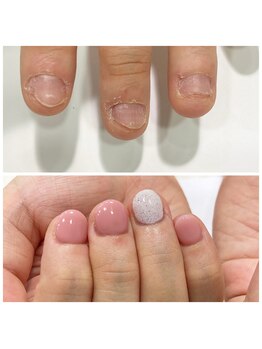 ミュゼドゥリッシュ(musee du riche)/深爪矯正